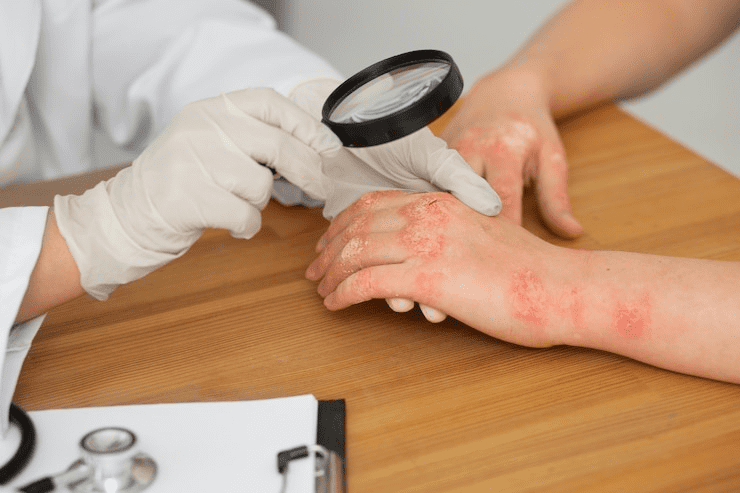 Eczema and Psoriasis: Managing Chronic Skin Diseases with Ayurveda