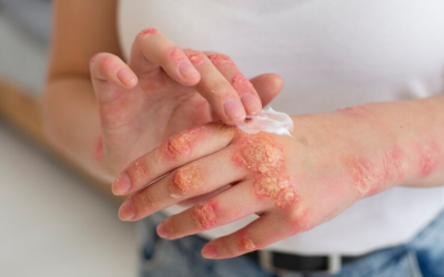 Harnessing the Power of Ayurveda to Heal Eczema and Other Skin Conditions
