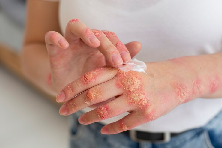 Harnessing the Power of Ayurveda to Heal Eczema and Other Skin Conditions