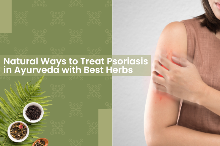 Best Ayurvedic Treatment for Psoriasis