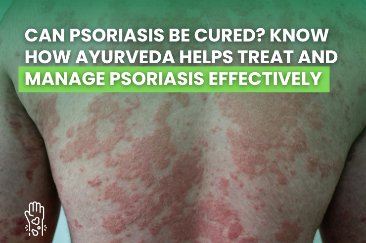 Ayurvedic treatment for psoriasis