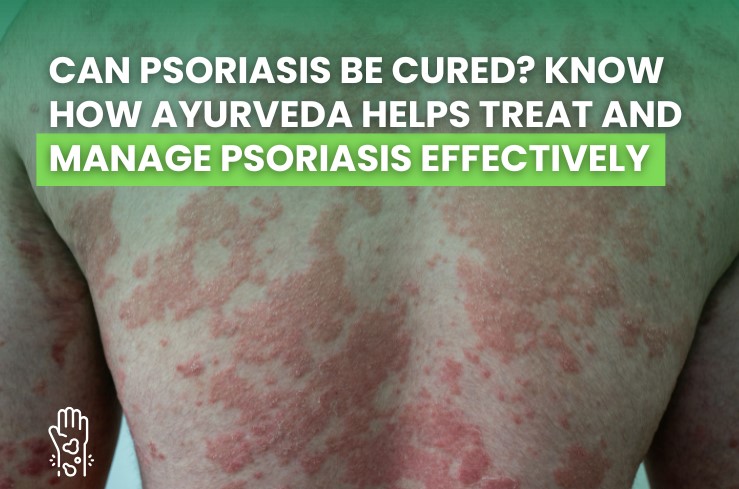 Ayurvedic treatment for psoriasis