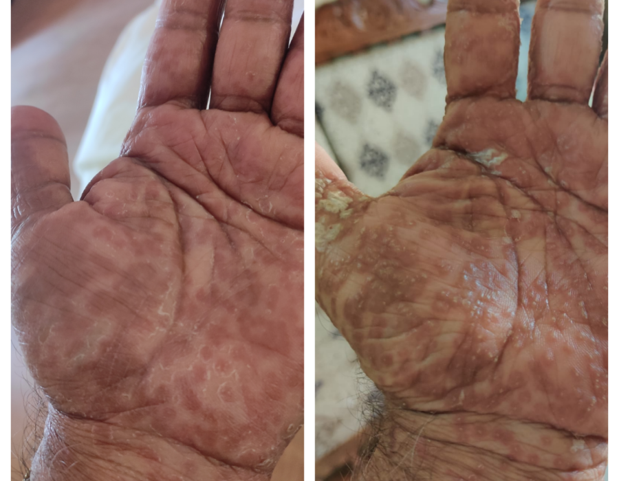 lichen planus